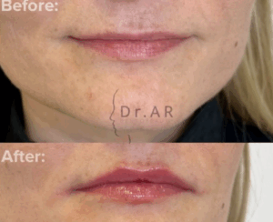 LIPS Here I’ve used 3 different techniques to bring out the upper lip and define the cupid's bow as well as rejuvenation of the lower lip. LÄPPAR Här har jag använt 3 olika tekniker för att få fram överläppen och definera amorbågen samt föryngring av underläppen.