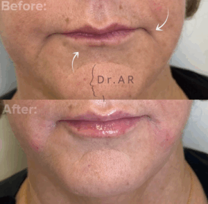 LIPS & MARIONETTE LINES Here I’ve used 2 different techniques for rejuvenation of the lips LÄPPAR & MARIONETTLINJER Här har jag använt 2 olika tekniker för föryngring av läpparna.