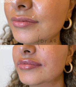 NASOLABIAL AND LIPS Here I’ve treated the nasolabial folds. In this case I’ve used a technique where I work in the deep layers to give support. Nasolabial folds are one of the most common areas where we can spot early signs of aging. Changes in the skin, facial skeleton, and soft tissue. Deep fat compartments tend to atrophy with age, while the superficial compartments may be more prone to hypertrophy. For the lips I’ve worked on making the upper lip more straight aswell as rejuventaion of lips. The lips are swollen on the after picture. NASOLABIAL OCH LÄPPAR Här har jag behandlat nasolabialvecken. I det här fallet har jag använt en teknik där jag arbetar i de djupa lagren för att ge stöd. Nasolabialveck är ett av de vanligaste områdena där vi kan upptäcka tidiga tecken på åldrande. Förändringar i huden, ansiktets skelett och mjukvävnad. Djupa fettområden tenderar att atrofieras med åldern, medan de ytliga områdena är mer benägna för hypertrofi. För läpparna har jag arbetat med att göra överläppen mer rak och föryngring av läpparna. Läpparna är svullna på efter bilden.
