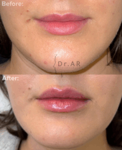 LIPS For the lips I’ve focused on evening out the volume in the upper lip and also defining the cupid’s bow. LÄPPAR Här har jag fokuserat på att jämna ut volymen i överläppen och även att definiera amorbågen.