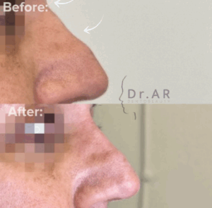NOSE Here I’ve placed filler on the nasal dorsum to achieve a more straight looking nose. NÄSA Här har jag placerat filler på näsryggen för att få en mer rak näsa.