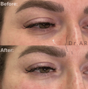 TEAR TROUGH Here I’ve performed a very common treatment: Tear trough. Do you have dark shadows, circles or hollows under your eyes that make you look tired? A correctly performed tear trough treatment with fillers reduces the problematic areas under the eyes, which makes you look more energetic and fresh. TEAR TROUGH Här har jag utfört en mycket vanlig behandling: Tear trough. Har du mörka skuggor, ringar eller ihåligheter under ögonen som gör att du ser lite trött ut? En korrekt utförd tear trough-behandling med fillers minskar de problematiska områdena under ögonen vilket gör att du ser piggare och fräschare ut.