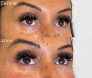TEAR TROUGH Here I’ve performed a very common treatment: Tear trough. Do you have dark shadows, circles or hollows under your eyes that make you look tired? A correctly performed tear trough treatment with fillers reduces the problematic areas under the eyes, which makes you look more energetic and fresh. TEAR TROUGH Här har jag utfört en mycket vanlig behandling: Tear trough. Har du mörka skuggor, ringar eller ihåligheter under ögonen som gör att du ser lite trött ut? En korrekt utförd tear trough-behandling med fillers minskar de problematiska områdena under ögonen vilket gör att du ser piggare och fräschare ut.