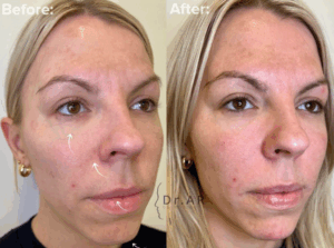 TEAR TROUGH, NASOLABIAL, LIPS & CHIN. Small adjustments makes a big discreet difference. Here I’ve worked on rejuvenation of different areas.