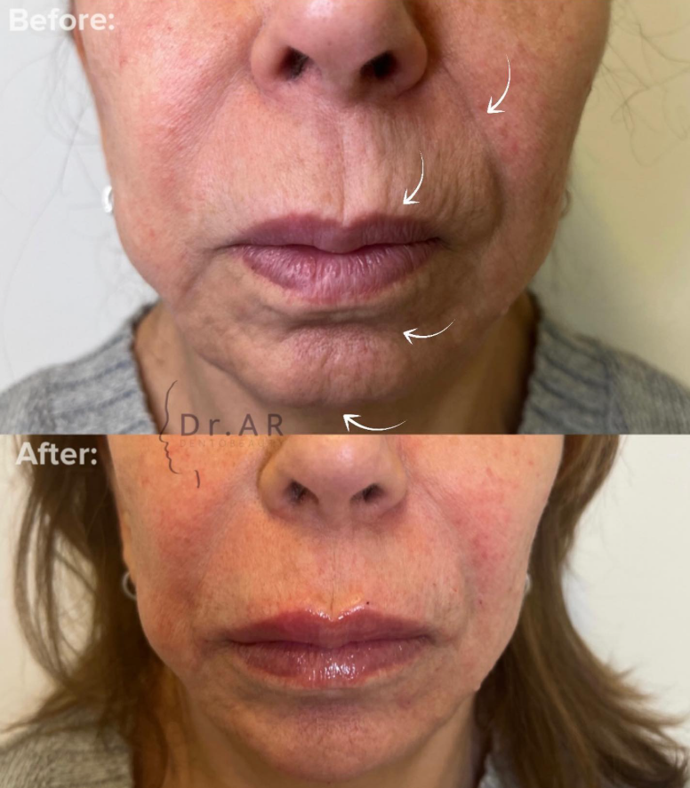 Lips, chin & nasolabial folds Here I’ve worked with rejuvenation of M-shaped lips (which is something you build up step by step. In this client's case, 2 sessions are required and this is the first session), chin region and nasolabial folds. In the picture, the lips are swollen. Läppar, haka & nasolabiala linjer Här har jag jobbat på föryngring av M-formade läppar (vilket är något man bygger upp steg för steg. I denna klients fall så behövs det 2 tillfällen och detta är första tillfället.), hakregion och nasolabiala linjer. På bilden är läpparna svullna.