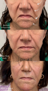 NASOLABIAL, MIDFACE, MARIONETTE LINES, CHIN Small adjustments makes a big discreet difference. Here I’ve worked on rejuvenation of different areas. NASOLABIALA, MELLANANSIKTET MARIONETTLINJER, HAKA Små justeringar gör en stor diskret skillnad. Här har jag arbetat med föryngring av olika områden.